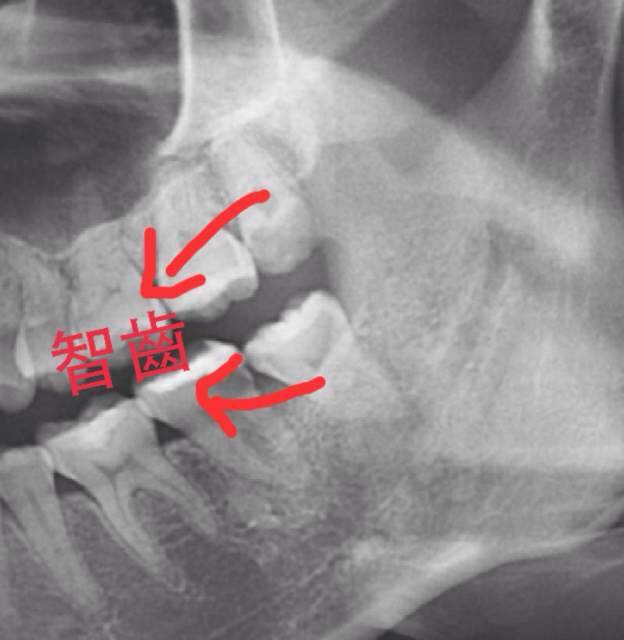 我的智齒要拔嗎? 我的智齒要拔嗎?