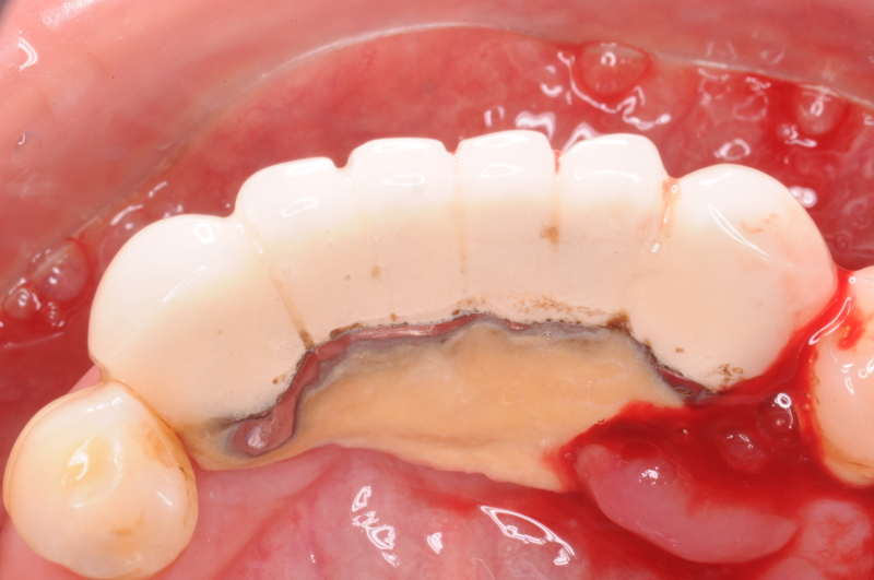 嚇死人的牙結石!!! 嚇死人的牙結石!!!