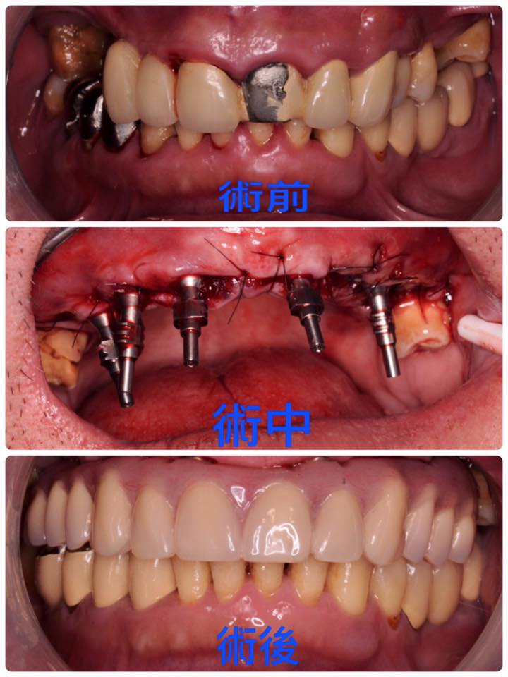 『All on 4全口重建案例分享』 『All on 4全口重建案例分享』