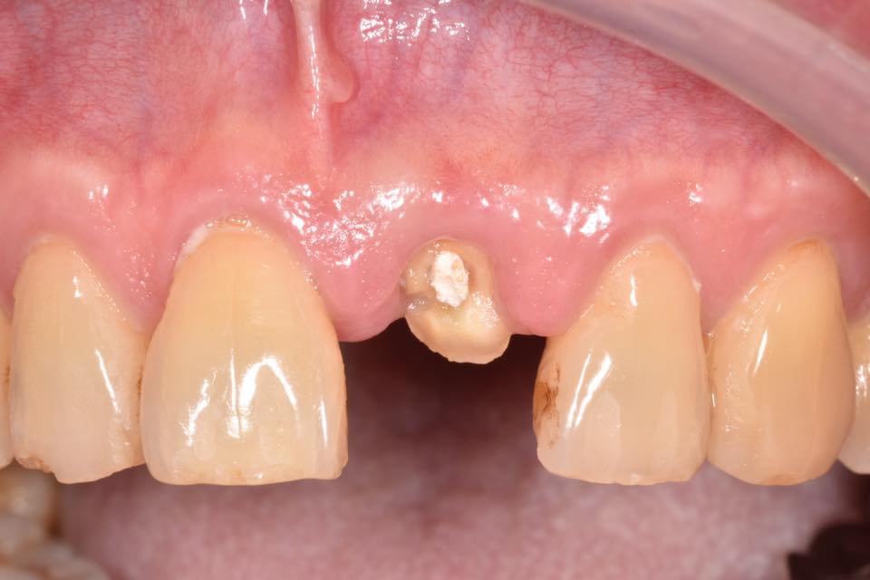 牙齒P蟹殼,看誰比較硬! 牙齒P蟹殼,看誰比較硬!