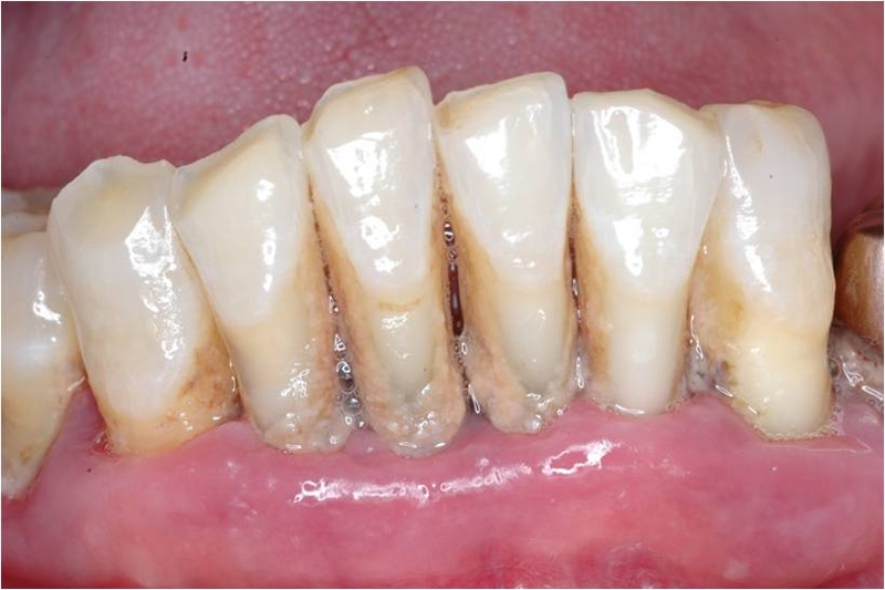 中風! 牙周病! 有關係嗎? 中風! 牙周病! 有關係嗎?