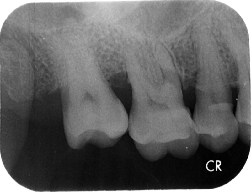 <瘻管的故事> <瘻管的故事>