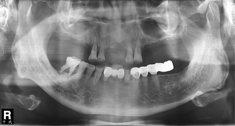 All-on-4精彩案列分享 All-on-4精彩案列分享