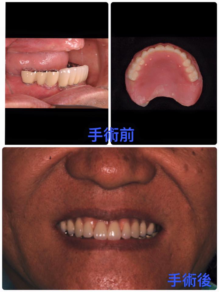 All-on-4 全口重建案例分享 All-on-4 全口重建案例分享