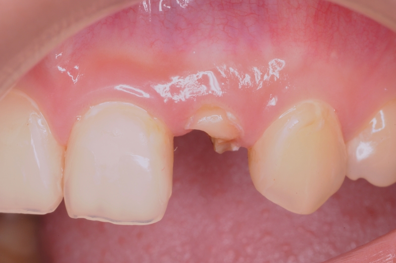 要命的芒果乾之還我一顆牙!! 要命的芒果乾之還我一顆牙!!