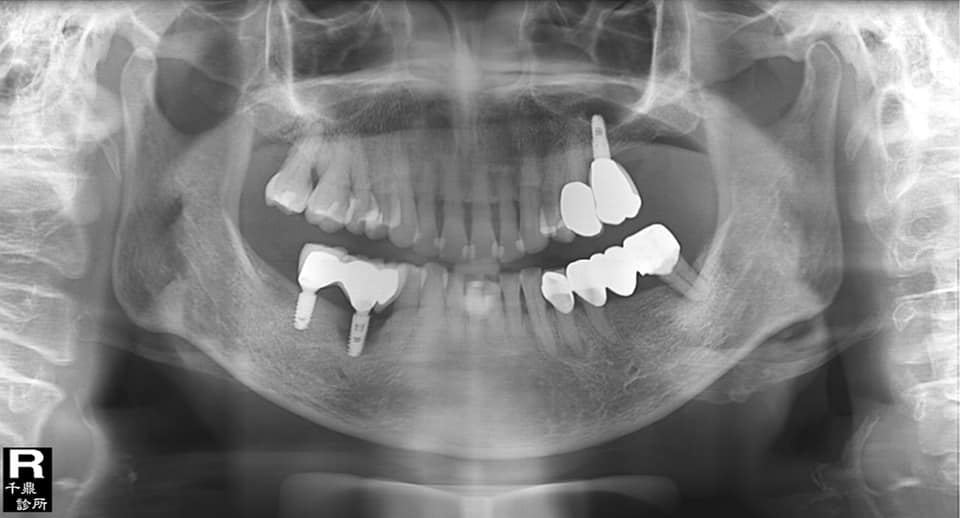 植牙也會生病?<中篇> 植牙也會生病?<中篇>