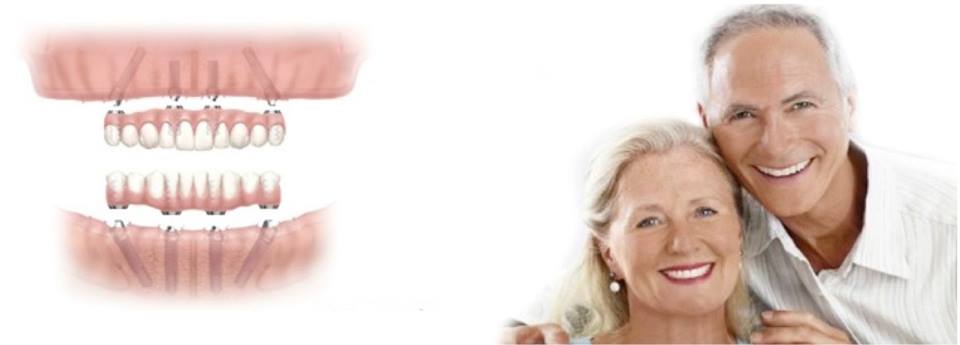 全口重建的專家 All-on-4 是您最佳的選擇 全口重建的專家 All-on-4 是您最佳的選擇