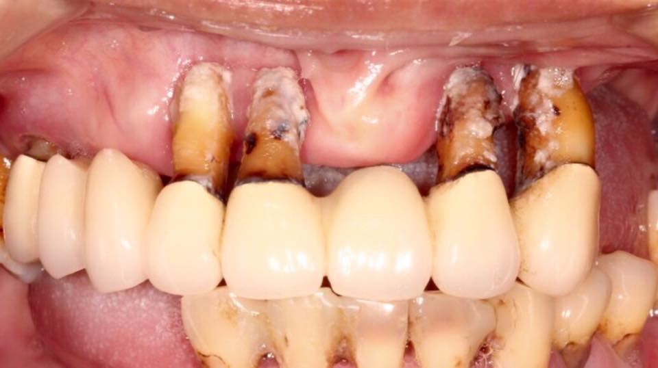 All-on-4 全口重建案例分享 All-on-4 全口重建案例分享