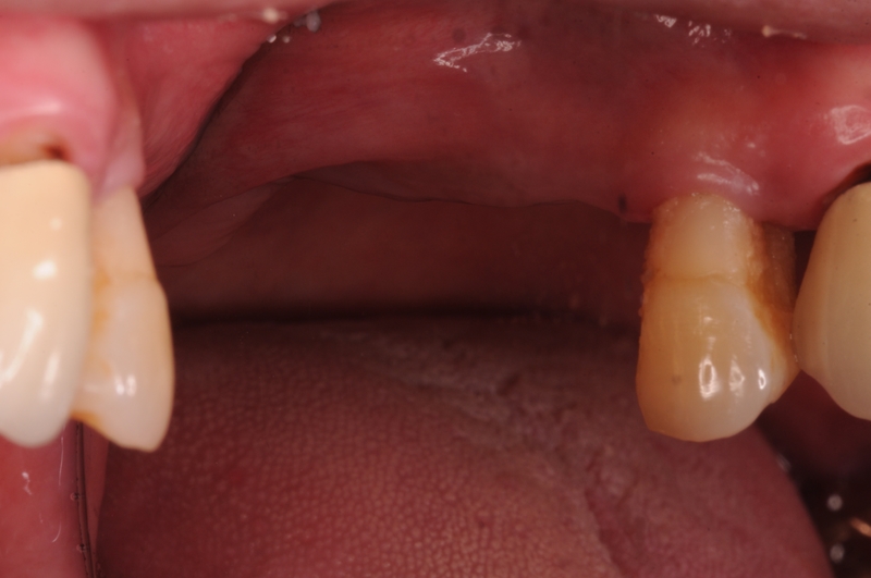 我有高血壓,可以植牙嗎? 我有高血壓,可以植牙嗎?