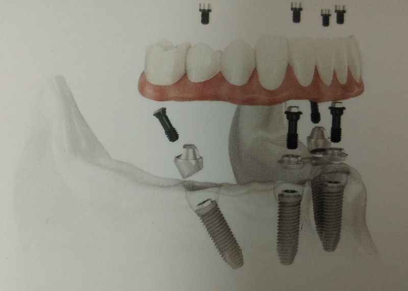 說這麼多,到底什麼是All-on-4™?? 說這麼多,到底什麼是All-on-4™??
