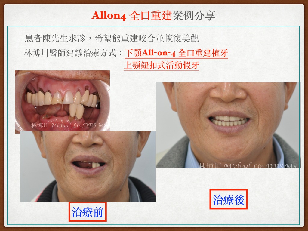 全口重建案例分享